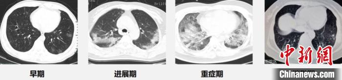 《新冠肺炎CT早期征象与鉴别诊断》出版并免费共享